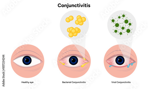 Viral and bacterial conjunctivitis. Ophthalmology diseases