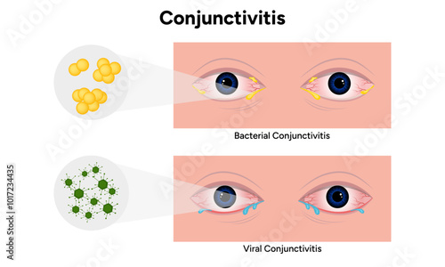 Viral and bacterial conjunctivitis. Ophthalmology diseases