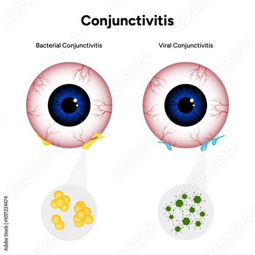 Viral and bacterial conjunctivitis. Ophthalmology diseases