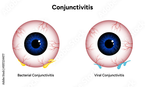Viral and bacterial conjunctivitis. Ophthalmology diseases
