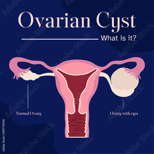 female reproductive system ovarian cyst illustration