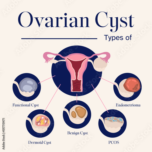 female reproductive system types of ovarian cyst illustration
