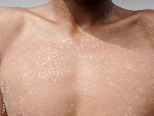 Tinea Versicolor on the chest, characterized by small, white patches of hypopigmentation. photo