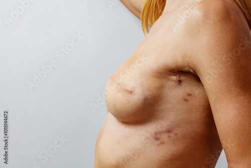 Φωτογραφία Post-mastectomy breast reconstructed with notable surgical scars