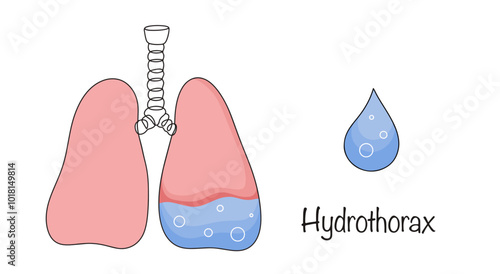 Hydrothorax