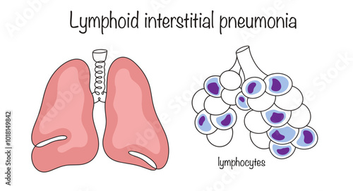 Lymphoid interstitial pneumonia