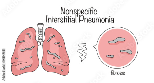 Nonspecific Interstitial Pneumonia