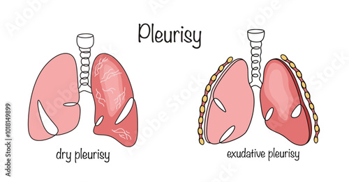 Pleurisy