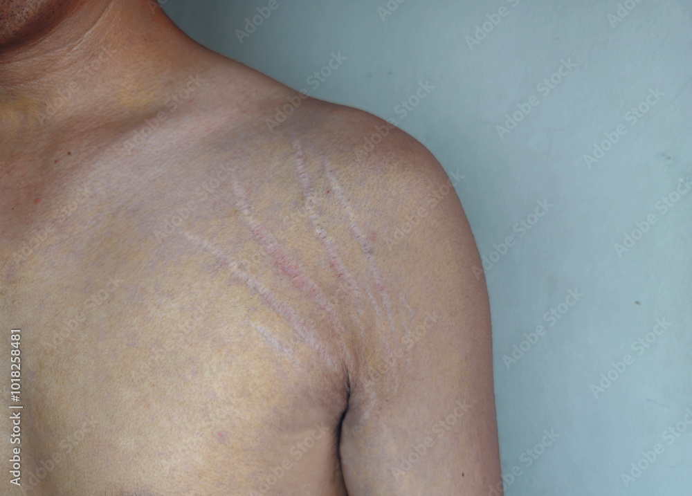 Fototapeta premium isolated stretch marks on armpit skin area 