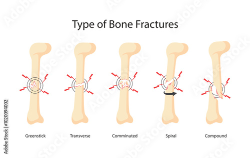 type of bone fractures