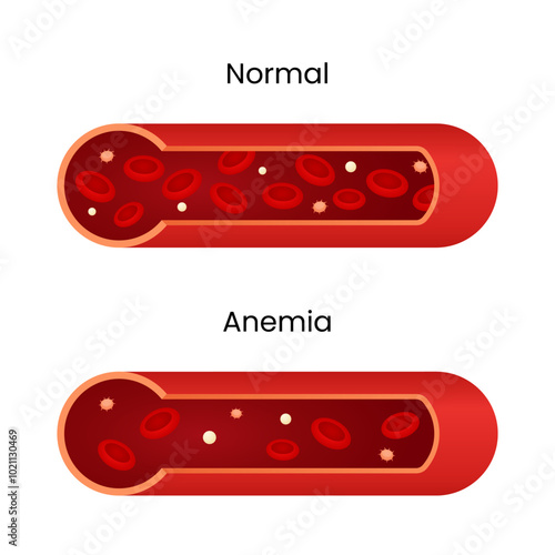Difference Between Normal Blood and Anemia
