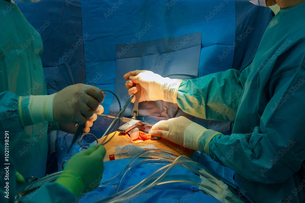 An operating room at hospital is occupied by a medical team of surgeons performing open heart surgery on patient An operating room at hospital is occupied by a medical team of surgeons performing open heart surgery on patient