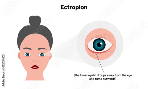 Ectropion eye ophthalmology problem infographic 