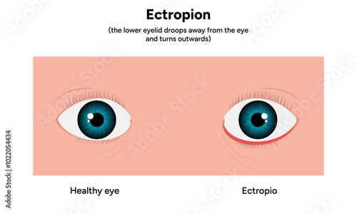 Ectropion and healthy eye ophthalmology problem 