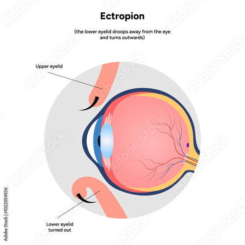 Ectropion eye ophthalmology problem infographic 