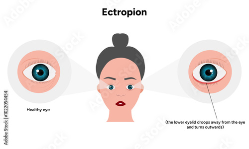 Ectropion and healthy eye ophthalmology problem 