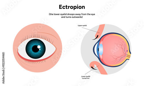 Ectropion eye ophthalmology problem infographic diagram
