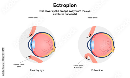 Entropion and healthy eye ophthalmology problem infographic 