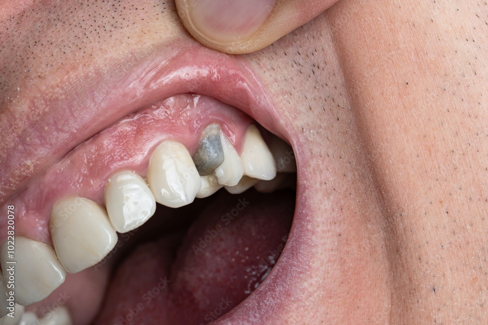 Obraz premium Caucasian male open mouth and teeth with broken upper premolar tooth after dental root canal treatment. Dark gray dental cement before permanent new crown. Close up macro shot