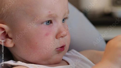 Infection on the face of baby caused by insect, mosquito or bee bites. Closeup.