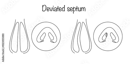 Deviated septum