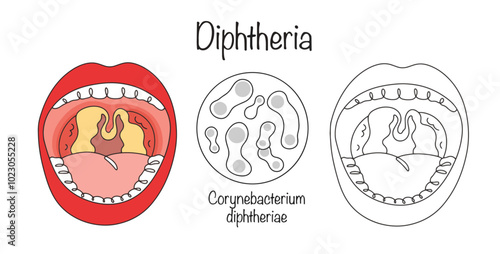 Diphtheria