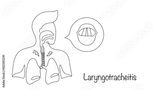 Laryngotracheitis