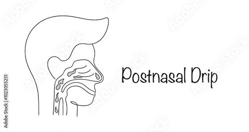 Postnasal Drip