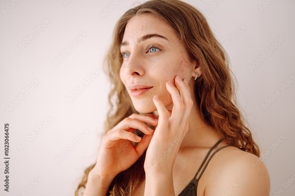 Young woman with acne and rashes on her face. Dermatology, cosmetology, skin care. Natural skin. Young woman with acne and rashes on her face. Dermatology, cosmetology, skin care. Natural skin.