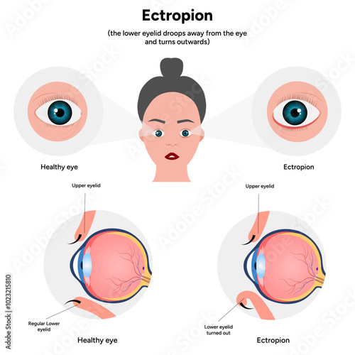 Ectropion and healthy eye ophthalmology problem