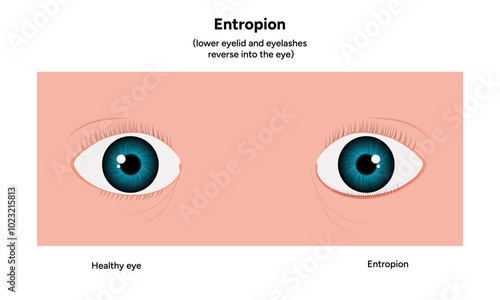Entropion and healthy eye ophthalmology problem
