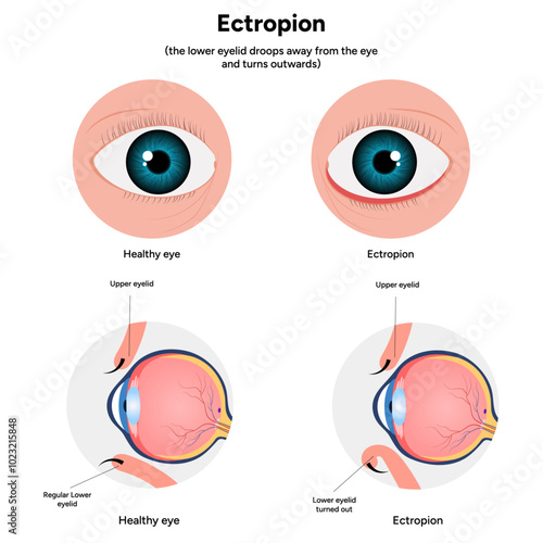 Ectropion and healthy eye ophthalmology problem