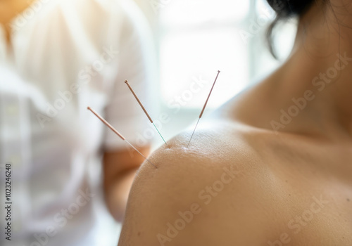 Patient is receiving acupuncture treatment on their shoulder, with needles strategically placed to alleviate pain