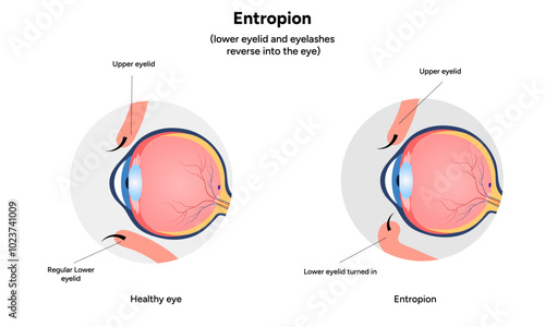 Entropion and healthy eye ophthalmology problem diagram infographic