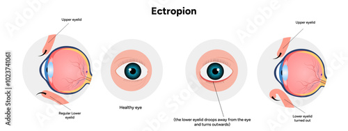 Ectropion and healthy eye ophthalmology eye problem infographic 