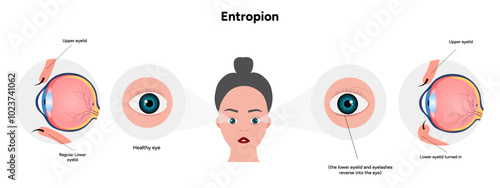 Entropion and healthy eye ophthalmology eye problem diagram
