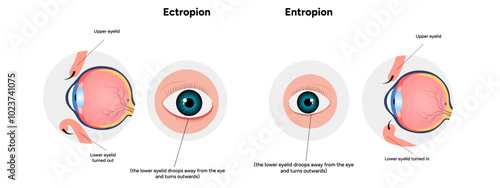 Entropion and ectopion ophthalmology eye problem diagram