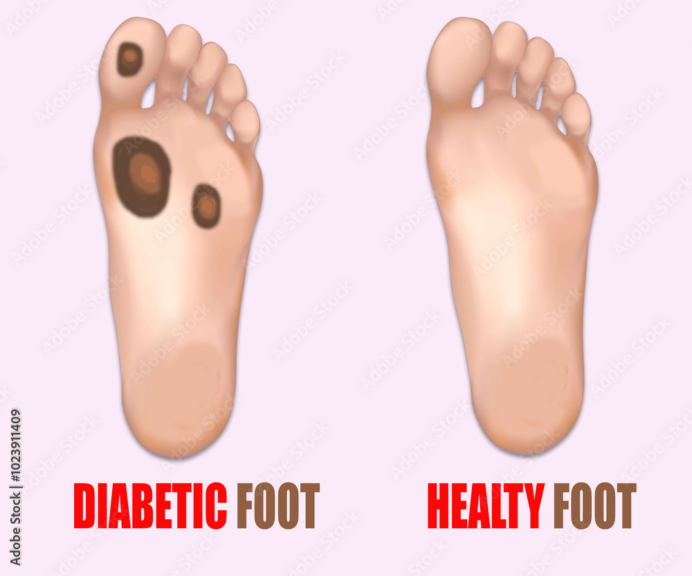 Healthy Foot vs. Diabetic Foot with Infected Ulcer 3D Illustration Healthy Foot vs. Diabetic Foot with Infected Ulcer 3D Illustration