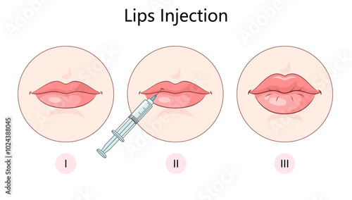lip augmentation filler procedure diagram hand drawn schematic vector illustration. Medical science educational illustration