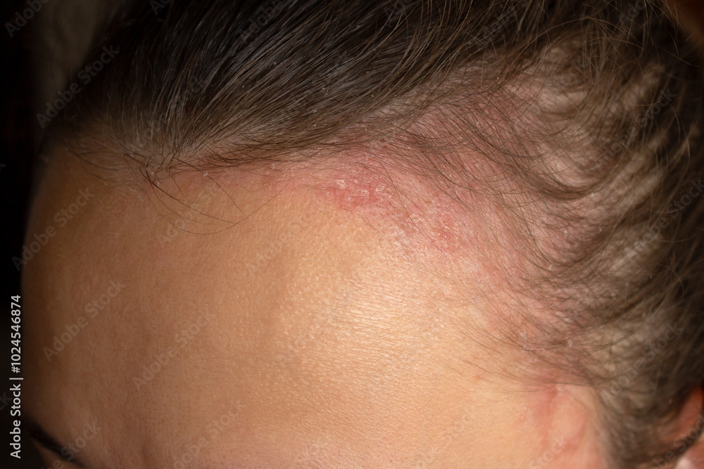Inflammation of the scalp in a young woman. Problems with dandruff, seborrhea, itching, redness, dryness, lichen, fungal infection. Skin disease, dermatitis. Red round spots on the head and forehead Inflammation of the scalp in a young woman. Problems with dandruff, seborrhea, itching, redness, dryness, lichen, fungal infection. Skin disease, dermatitis. Red round spots on the head and forehead