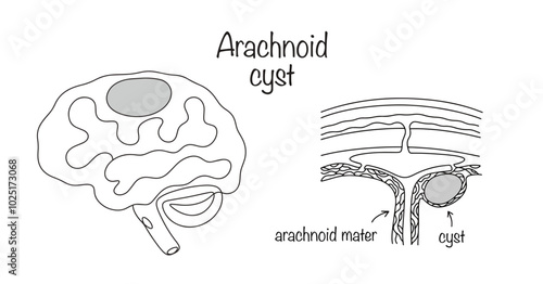 Arachnoid cyst