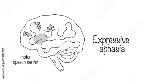 Expressive aphasia