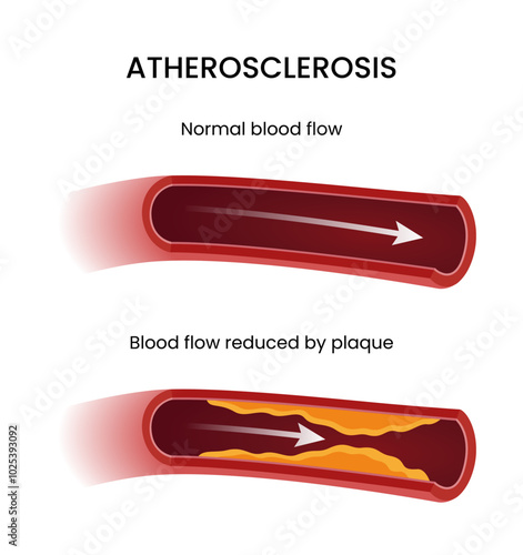Causes of Atherosclerosis Normal blood flow and Blood flow reduced by plaque