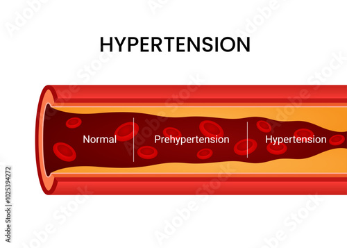 Stages of normal Blood flow Prehypertension and Hypertension