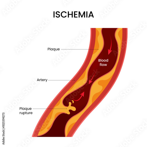 Causes of ischemia disease plaque rupture