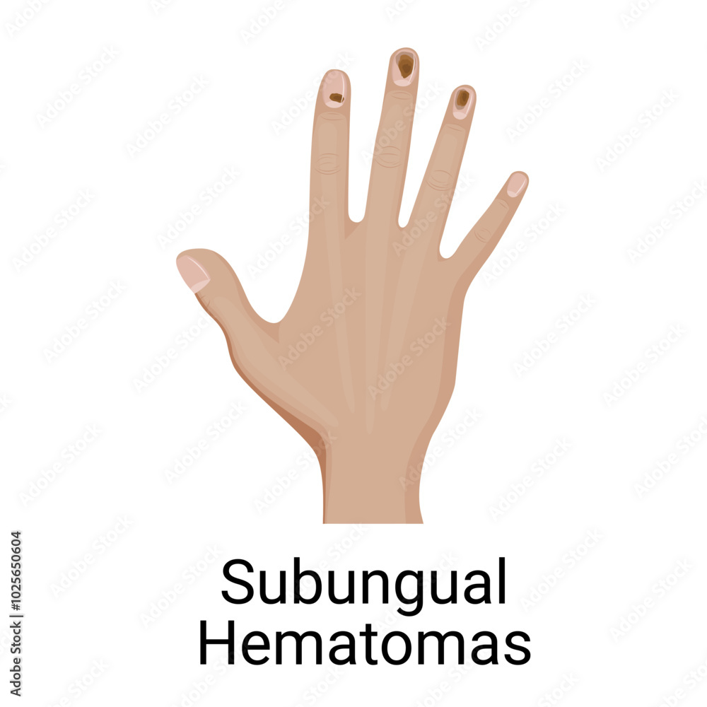 Fototapeta premium Subungual hematoma, blood underneath a fingernail.