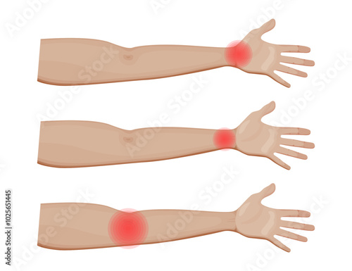 Shoulder and Elbow Joint Pain Vector Illustration