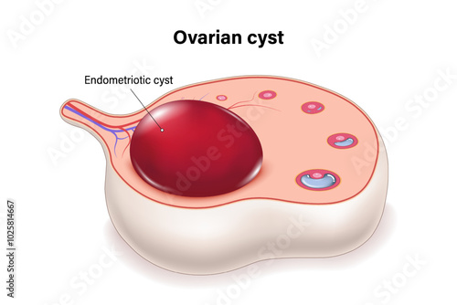 Endometriotic cyst cross section vector. Ovarian cysts. Female ovarian disease.