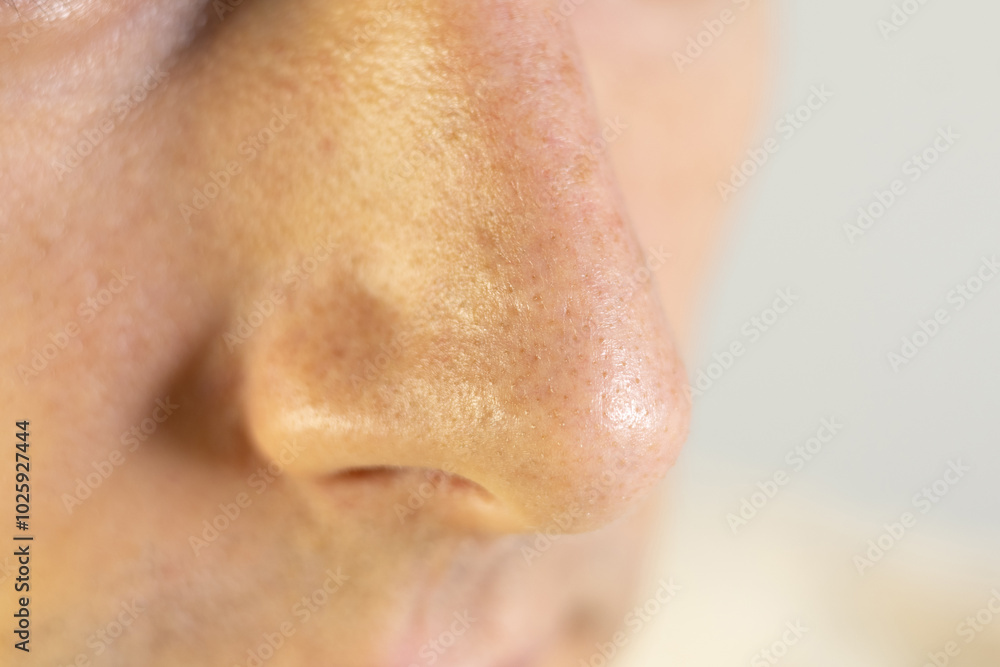 Naklejka premium Blackheads on mans nose. Acne problem, comedones. Close up.