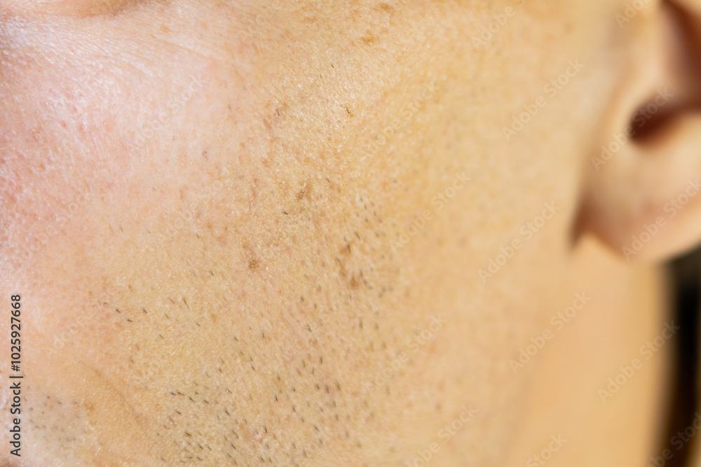 Scars after acne on mans face skin. Problem scin treatment. Close up. Scars after acne on mans face skin. Problem scin treatment. Close up.